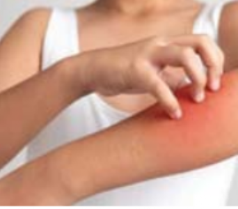 खाज थांबवण्याचे काही घरगुती उपाय